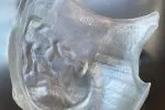 Myrava получила одобрение FDA на 3D-печатный болюс для лучевой терапии